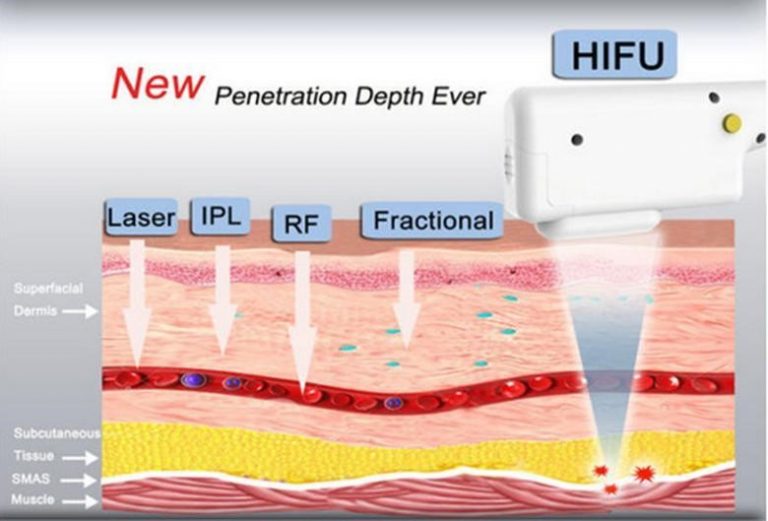 Esquema de penetración del HIFU en las capas profundas de la piel
