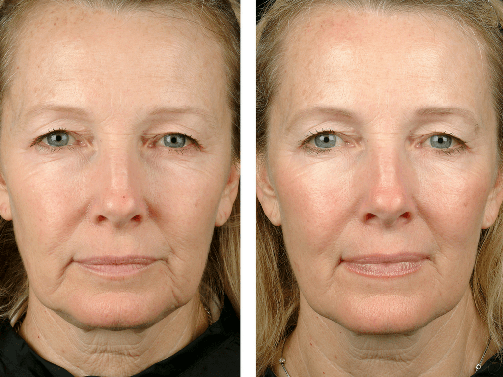 Resultado de reafirmación HIFU facial frontal, antes y después