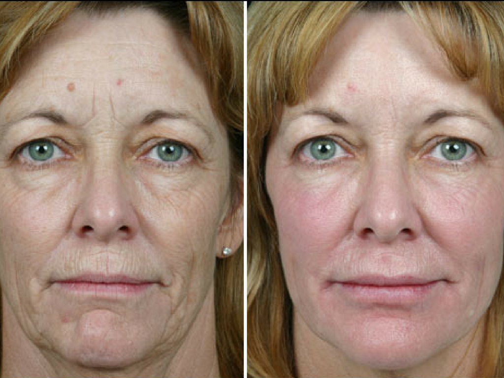 Resultado HIFU en rostro maduro, antes y después