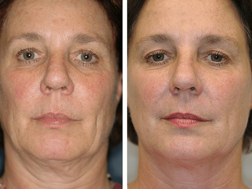 Resultado HIFU facial en óvalo y mejillas, antes y después