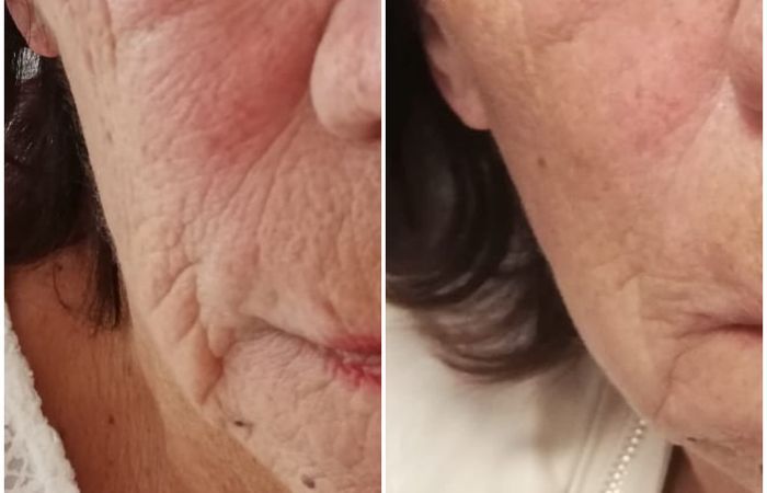 Resultado HIFU en mejilla y línea mandibular, antes y después