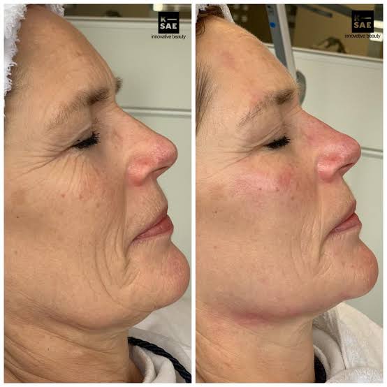 Resultado HIFU en papada y línea mandibular, antes y después
